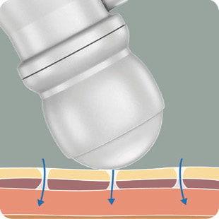 Step 2 - Elapromed - Illustration of Roll-on attachment on skin surface
