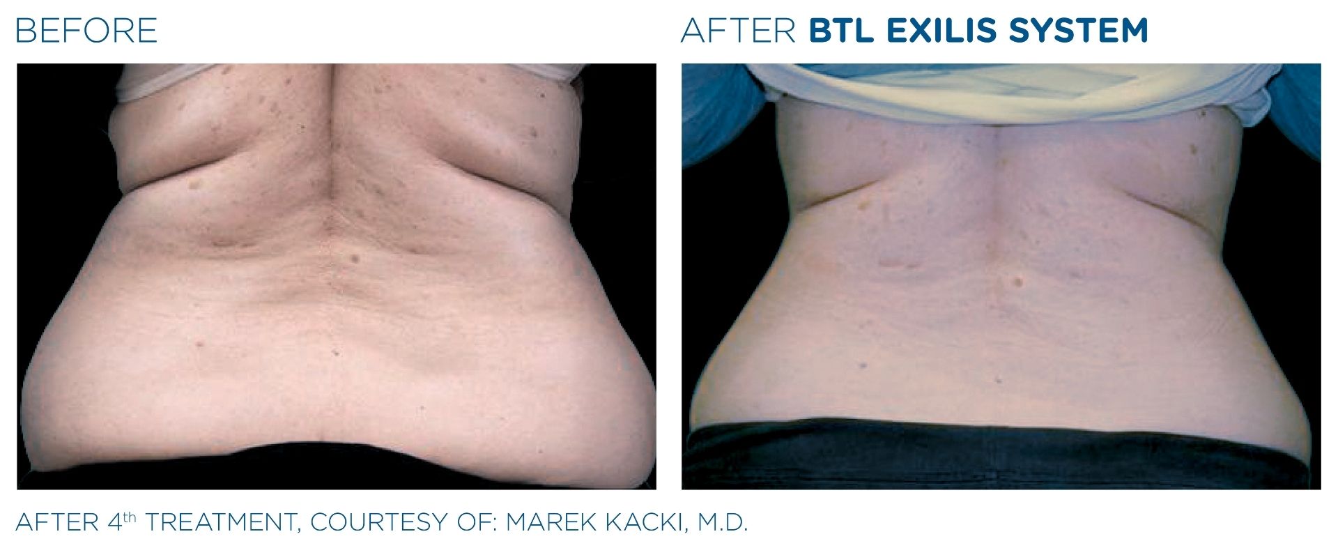Back Before & After Using the Exilis System