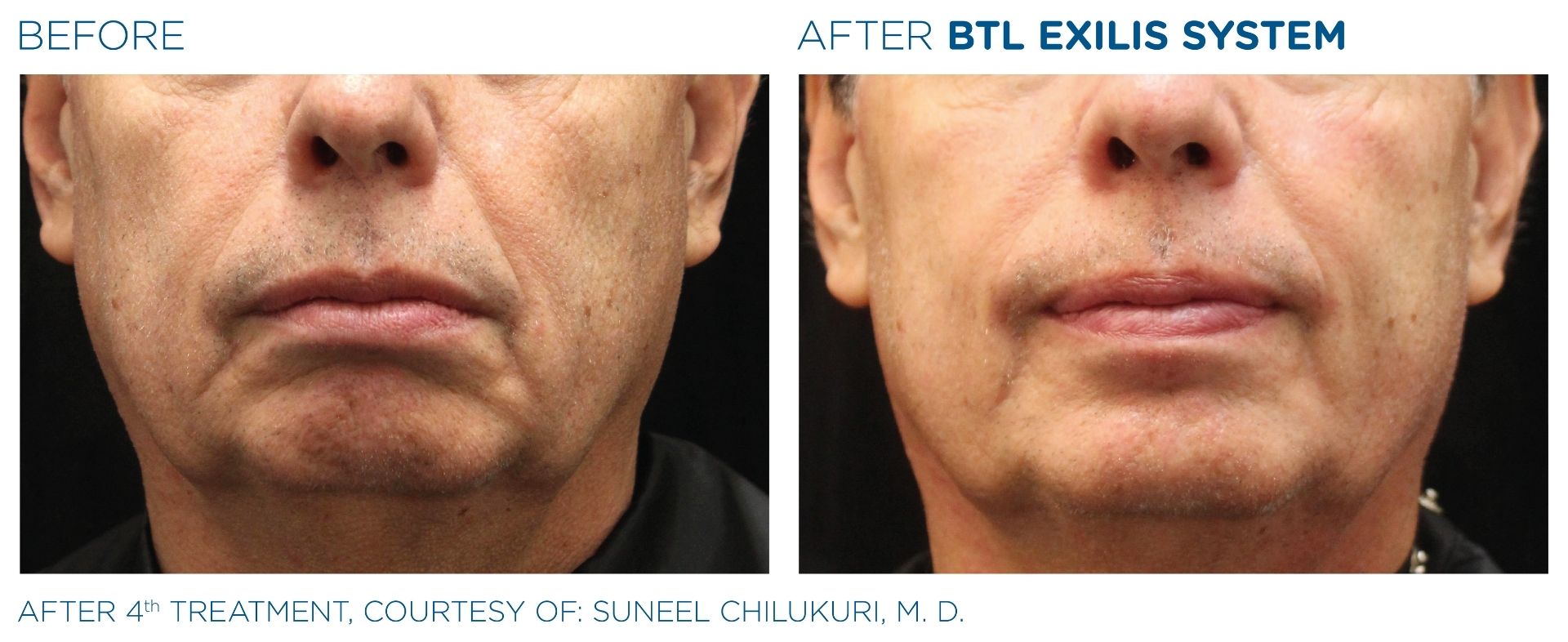 Man's Chin Before & After Using the Exilis System