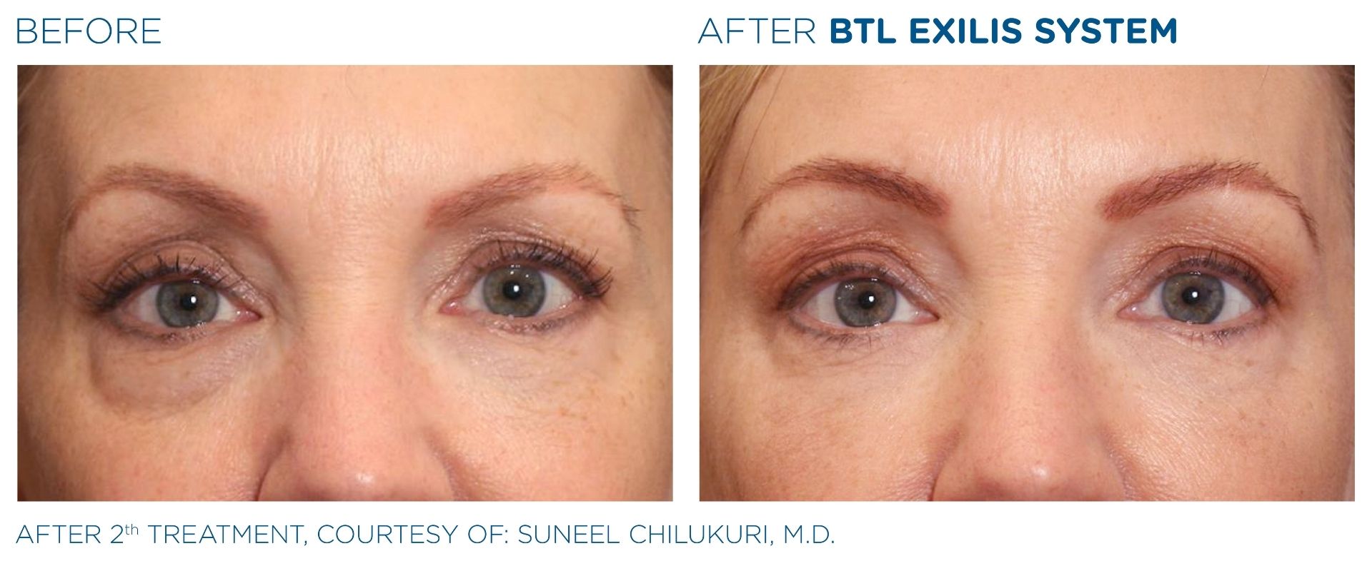 Eyes Before & After Using the Exilis System